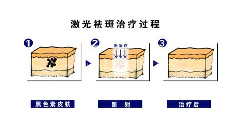 祛黄褐斑示意图