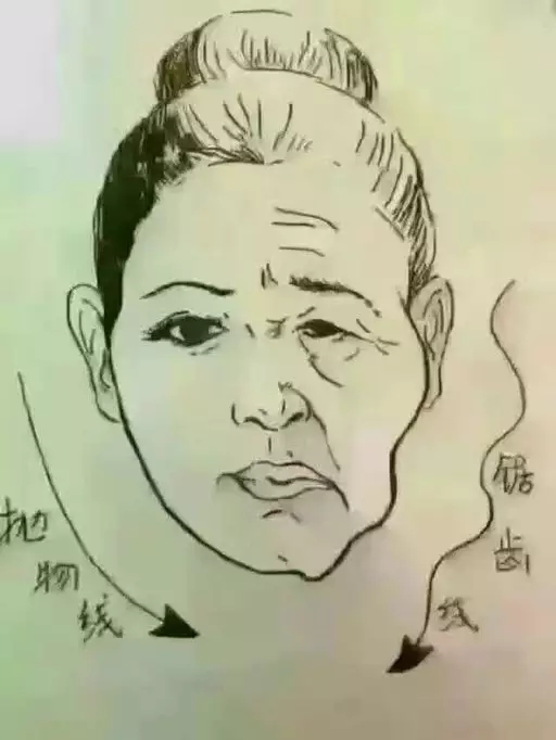 线雕埋线提升与传统拉皮手术区别是什么